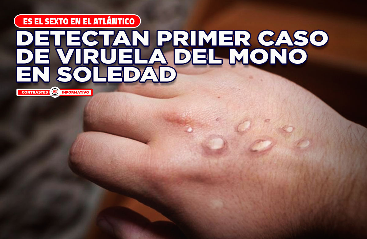 viruela simica soledad